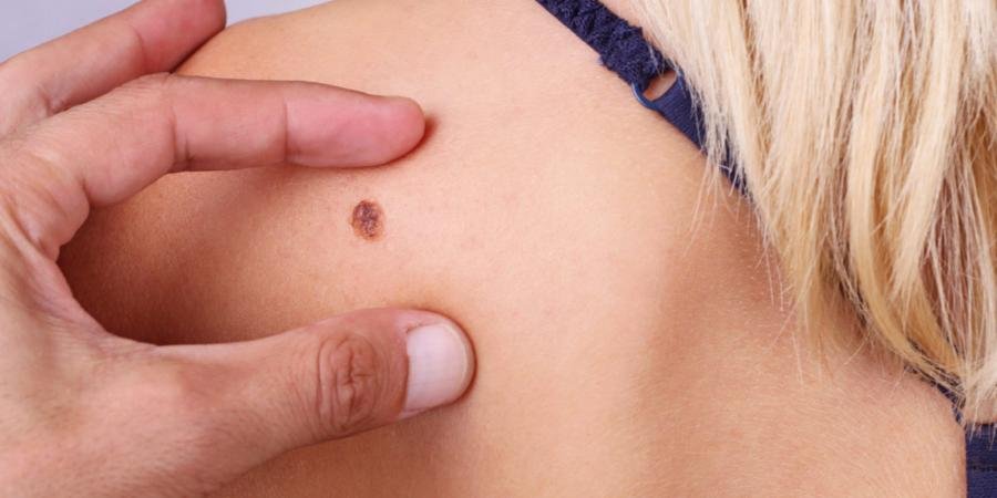 skin-cancer-check-in-brisbane