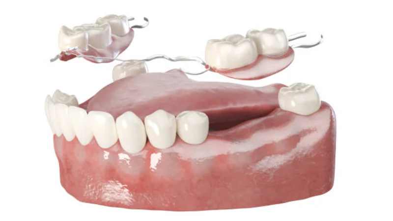 Full vs. Partial Dentures: The Differences Explained Simply